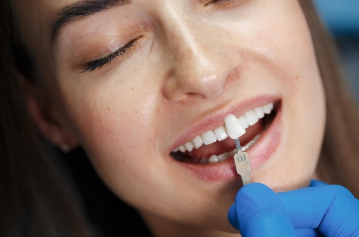 Crowns – Zirconium & DMLS