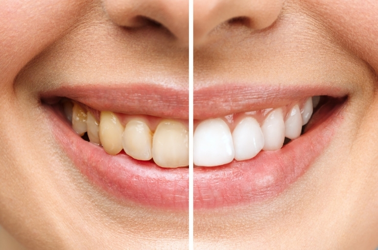 Teeth Whitening